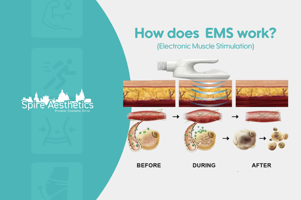 EMS treatment for post pregnancy weight loss treatment Swansea