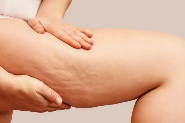 Image of woman showing leg with cellulite Swansea