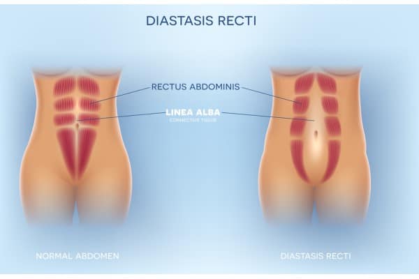 What Non-Surgical Options Are Available for Diastasis Recti Swansea?