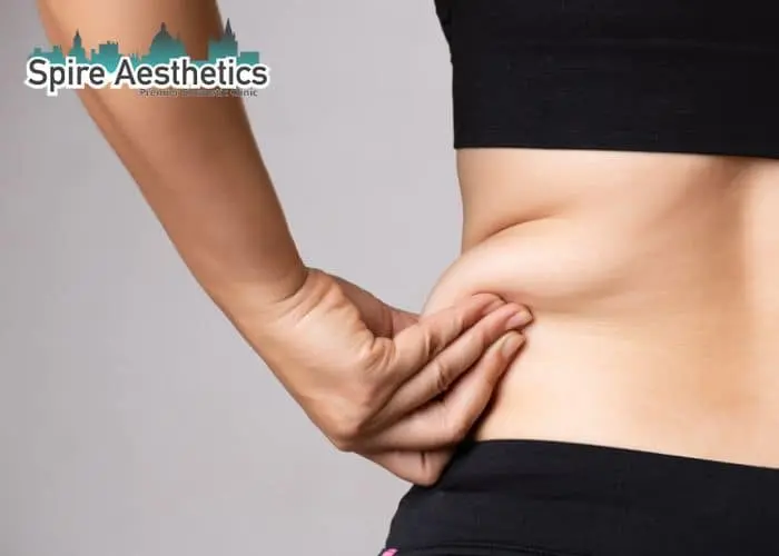Image of woman pinching fat on their hips Swansea. Fat Freezing treatment
