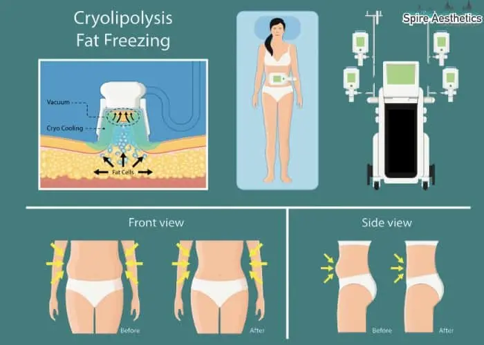 Fat freezing treatment Swansea benefits for competitions to remove stubborn fat deposits.