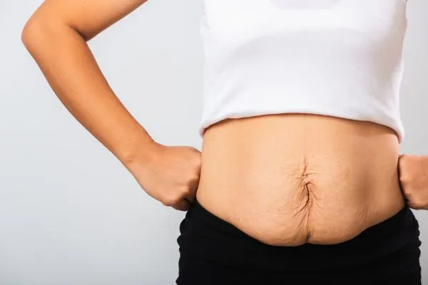 Image of a woman's stomach after weight loss with sagging skin following a gastric band Swansea