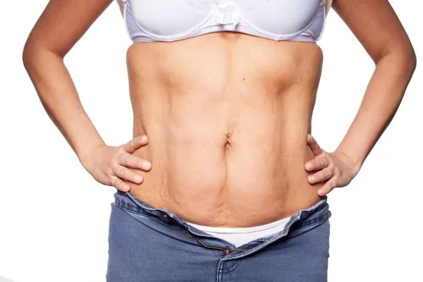 sagging skin on woman's stomach after weight loss injections Swansea
