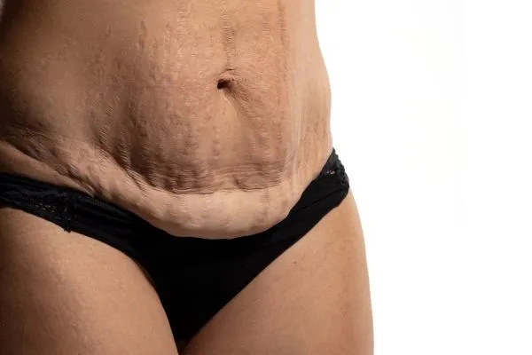 Image of womans stomach after weight loss injections Swansea showing saggy skin
