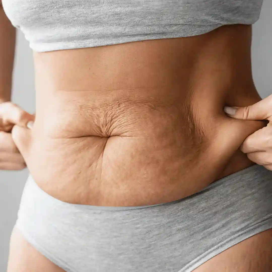 Is It Normal to Have Loose Skin After Pregnancy Swansea?