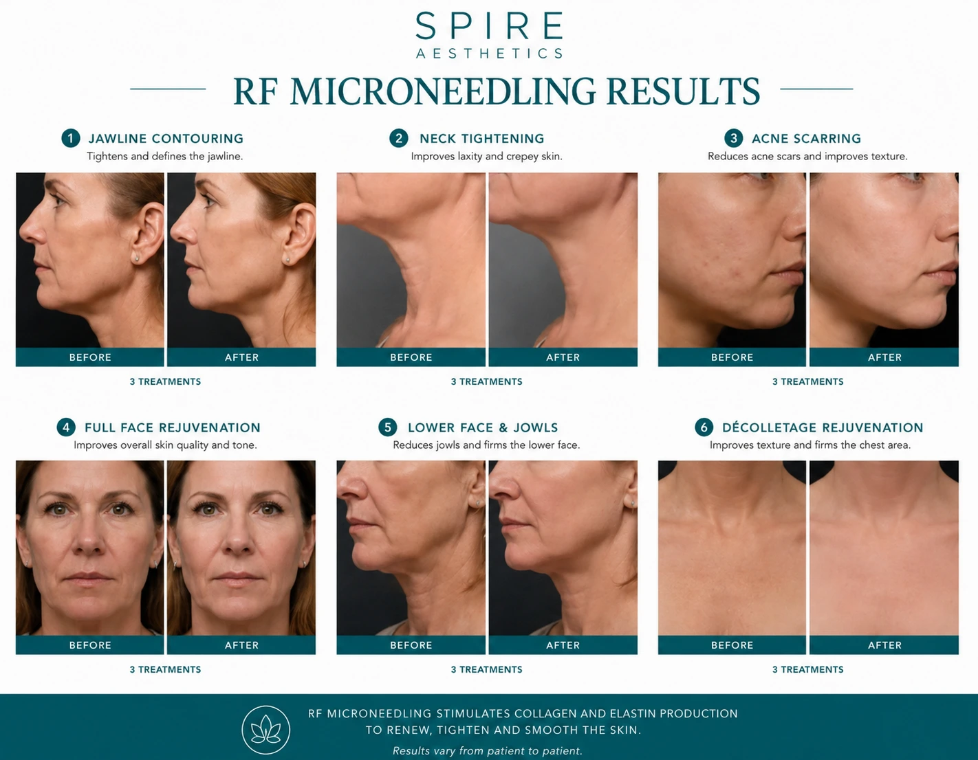 RF Microneedling Skin tightening Swansea results