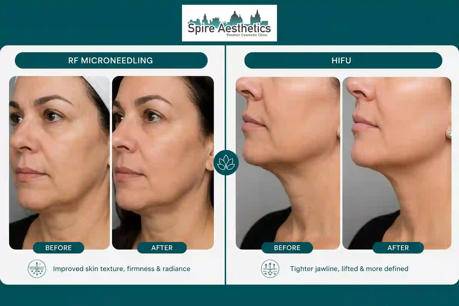Can RF Microneedling and HIFU Be Combined Swansea?