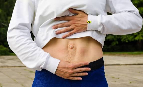 When Could Diastasis Recti Be the Missing Piece of the Puzzle Swansea?