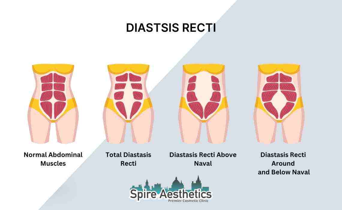 Is Non-Surgical Diastasis Recti Treatment Right for You? Common Concerns Answered Swansea